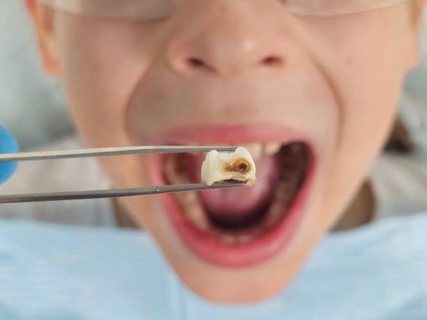 Best Emergency Broken Tooth Repair in Chewelah, WA